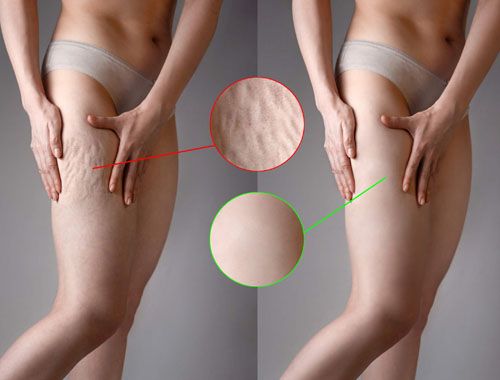 storz medical lifting i ujędrnienie