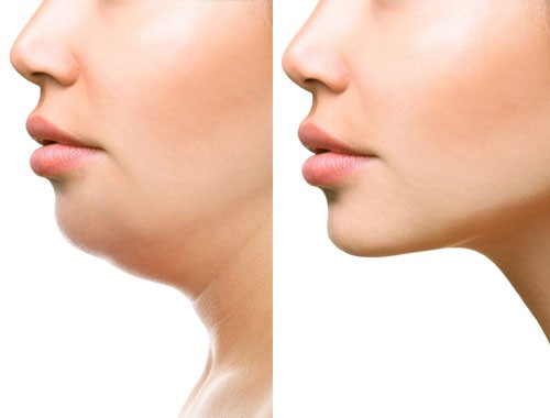 Lipoliza iniekcyjn prostaline